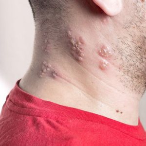 Folge 91: Herpes Zooster Impfung